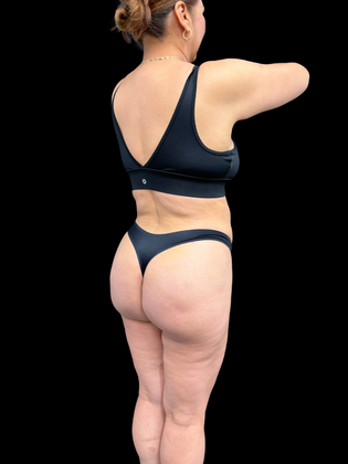Brazilian Butt Lift Case 3 - After