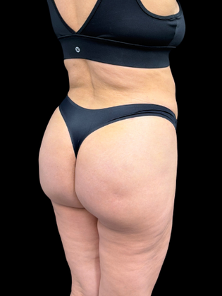 Brazilian Butt Lift: BBL 2 - After