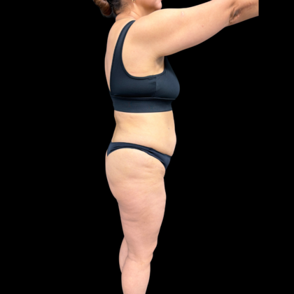 Brazilian Butt Lift: Case 34 - Before