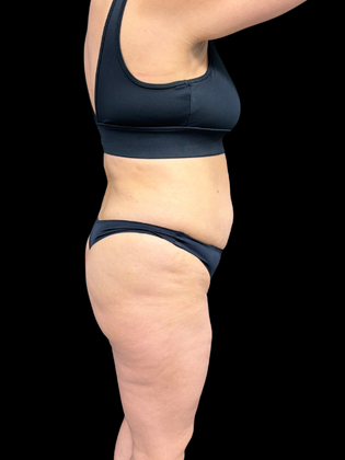 Brazilian Butt Lift: BBL 2 - Before