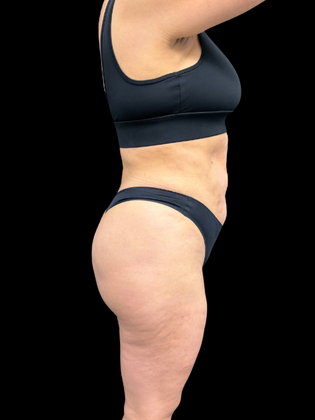 Brazilian Butt Lift: BBL 2 - After