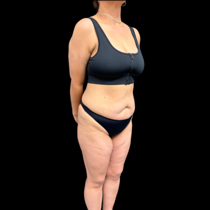 Brazilian Butt Lift: Case 34 - Before