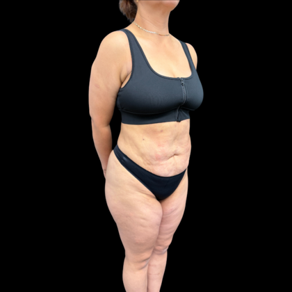 Brazilian Butt Lift: Case 34 - After