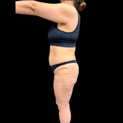 Liposuction: Case 22 - Before