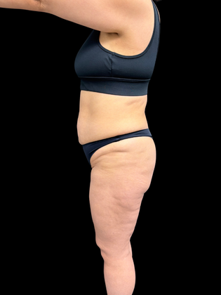 Liposuction: Liposuction  15 - Before