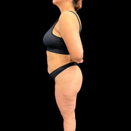 Liposuction: Case 22 - After