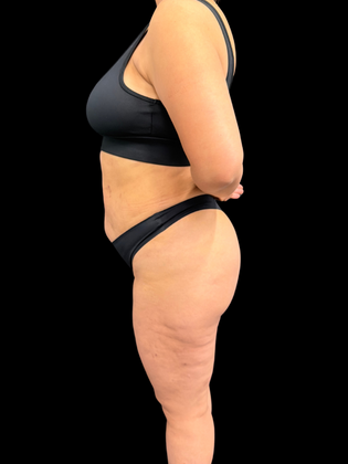 Liposuction: Liposuction  15 - After
