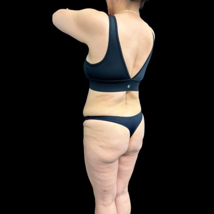 Liposuction: Case 22 - Before