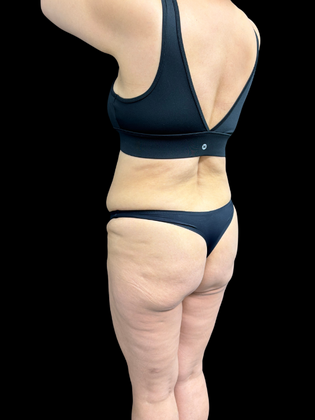Liposuction: Liposuction  15 - Before