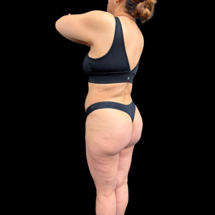 Liposuction: Case 22 - After
