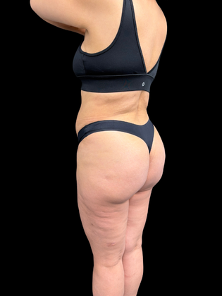 Liposuction: Liposuction  15 - After