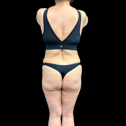 Liposuction Case 22 - Before