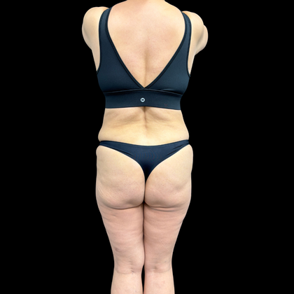 Liposuction: Liposuction  15 - Before