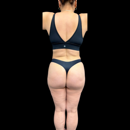 Liposuction Case 22 - After
