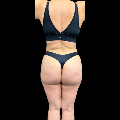 Liposuction: Liposuction  15 - After