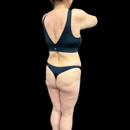 Liposuction: Case 22 - Before