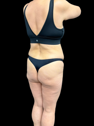 Liposuction: Liposuction  15 - Before