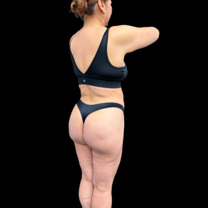 Liposuction: Case 22 - After