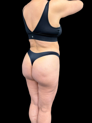 Liposuction: Liposuction  15 - After