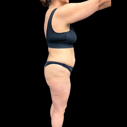 Liposuction: Case 22 - Before