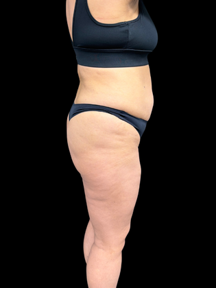 Liposuction: Liposuction  15 - Before