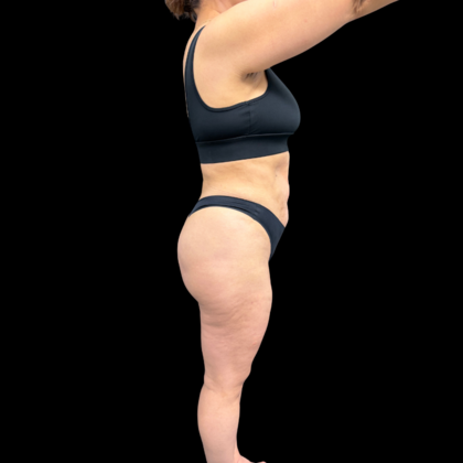 Liposuction: Case 22 - After
