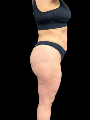 Liposuction: Liposuction  15 - After
