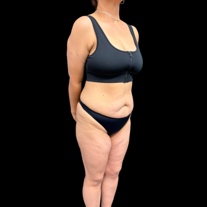 Liposuction: Case 22 - Before