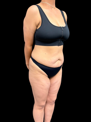 Liposuction Liposuction  15 - Before