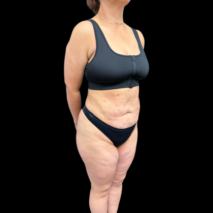 Liposuction: Case 22 - After
