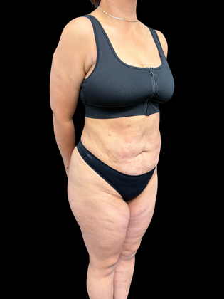 Liposuction Liposuction  15 - After