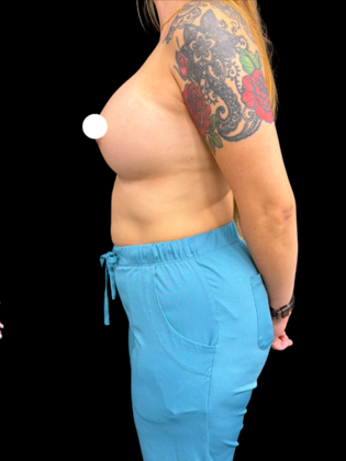 Breast Augmentation: Case 8 - After