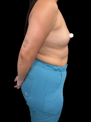Breast Augmentation: Case 8 - Before