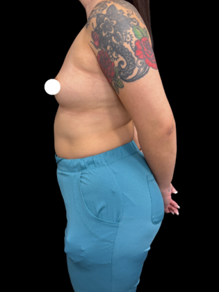 Breast Augmentation: Case 8 - Before