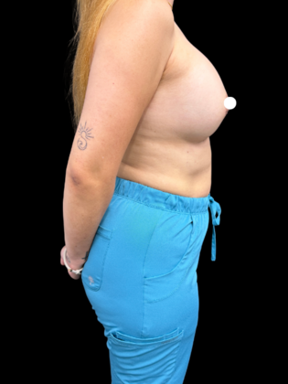 Breast Augmentation: Case 8 - After