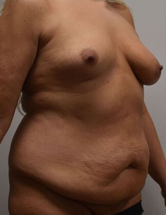 Massive Weight Loss : Case 216 - Before