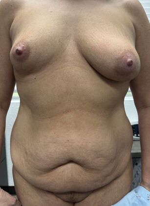 Massive Weight Loss : Case 216 - Before