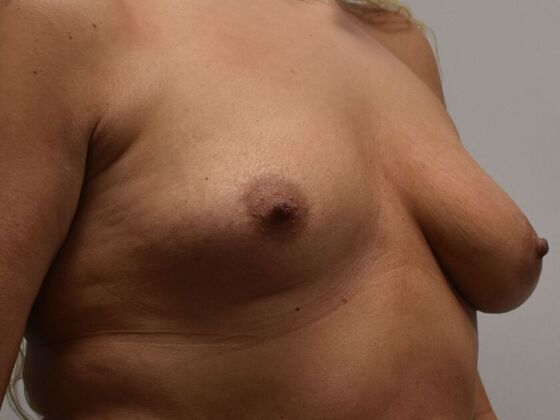 Breast Augmentation w/ Lift: Case 651 - Before
