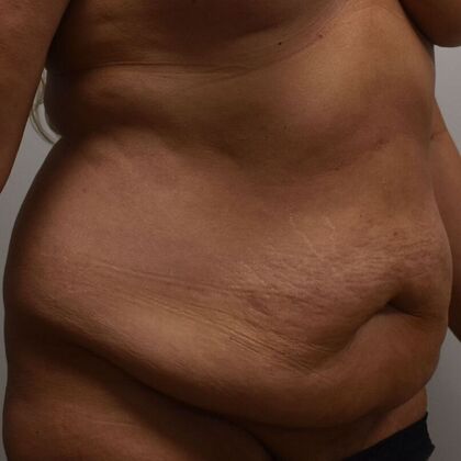 Tummy Tuck (Abdominoplasty): Case 592 - Before