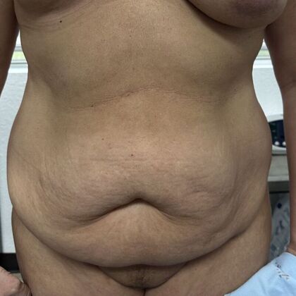 Tummy Tuck (Abdominoplasty) Case 592 - Before