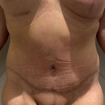 Tummy Tuck (Abdominoplasty) Case 592 - After