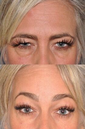 Eyelid Surgery Endoscopic brpwlift, upper and lower lids at 1 year