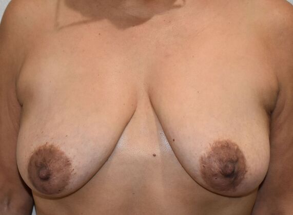 Breast Lift (Mastopexy) Case 274 - Before