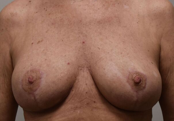 Breast Lift (Mastopexy) Case 275 - After