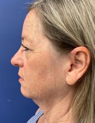 Facelift / Neck Lift Case 23 - Before
