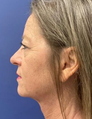 Facelift / Neck Lift Case 23 - After