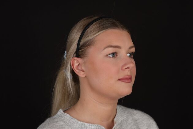 Face & Neck Lifts: Case 61 - Before
