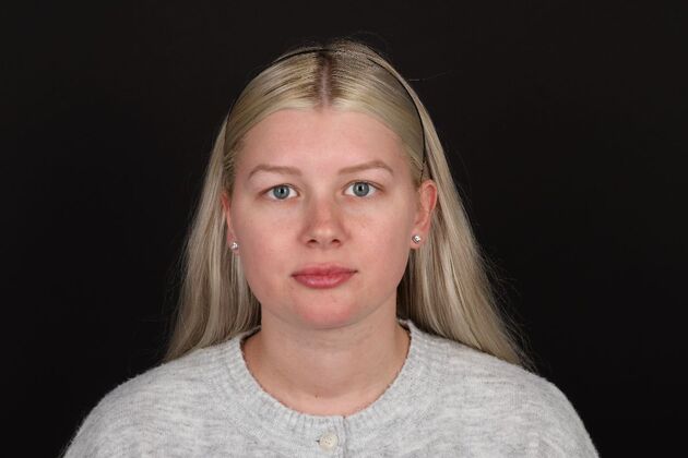 Face & Neck Lifts: Case 61 - After