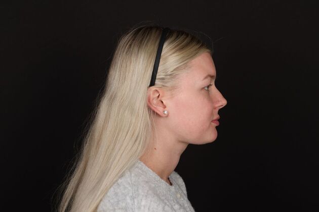 Face & Neck Lifts: Case 61 - After