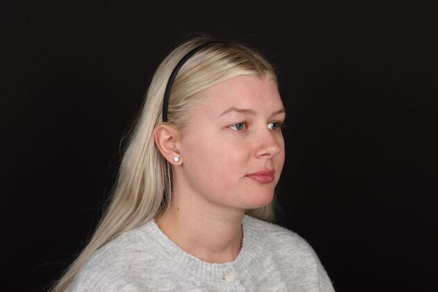 Face & Neck Lifts: Case 61 - After